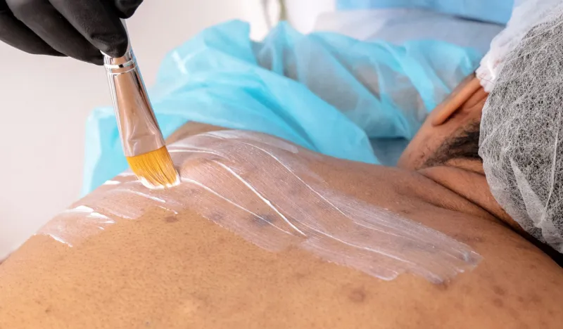 Cicatrices post-acnéiques : les technologies de régénération cutanée pour retrouver une peau lisse